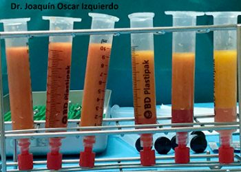 Lipofilling en cirugía podológica