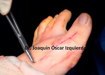 Caso de Hallux Límitus con problemas en el postoperatorio