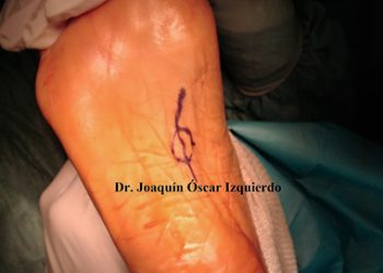 Fibroma Plantar, Fibromatosis Plantar, Enfermedad de Ledderhose