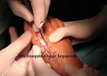 Osteotomía de Youngswick: porque los ángulos cuentan
