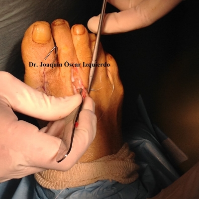 Hallux Abductus Valgus Severo