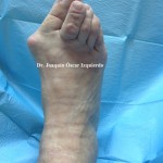 Hallux abductus valgus severo, con luxación de la segunda y tercera metatarsofalangica de grado